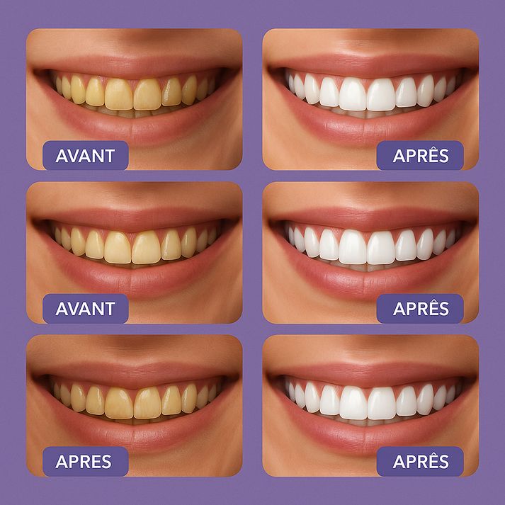 Smilekit Blanchisseur de Dent