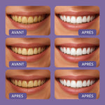 Charger l&#39;image dans la galerie, Smilekit Blanchisseur de Dent
