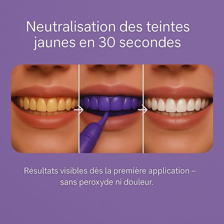 Smilekit Blanchisseur de Dent